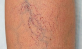 como tratar as varices nas mulleres